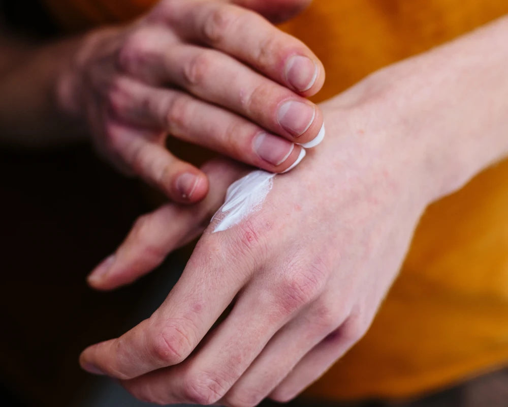 Topical compounded cream being applied to skin for dermatology treatment